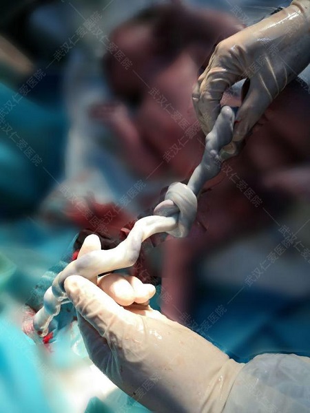 胎儿太顽皮，竟在妈妈肚子内里将脐带打了个结！