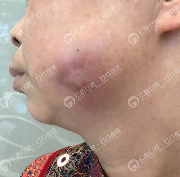 惊!女子智齿重复发炎未在意,面颊被脓肿穿破